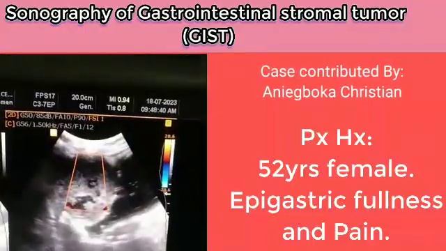 Sonography of GIST. Gastrointestinal stromal tumor ultrasound. Abdominal Ultrasound. смотреть онлайн