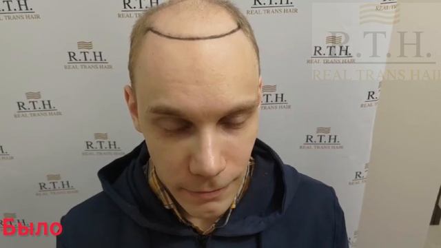 До и через 5 месяцев после пересадки волос смотреть онлайн