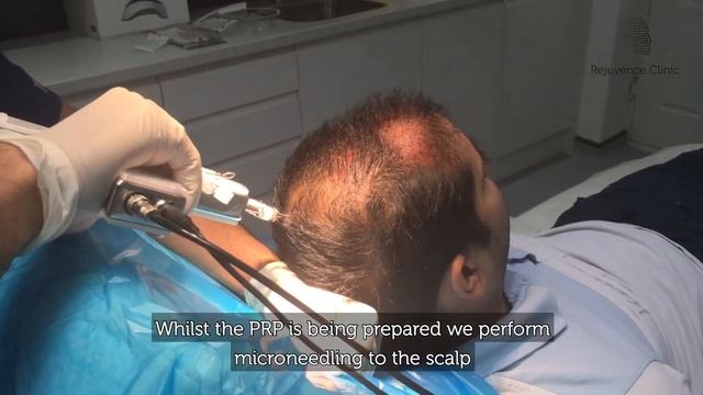 PRP & Stem Cells - Biocellular Restoration - Hair Loss | Rejuvence Clinic смотреть онлайн