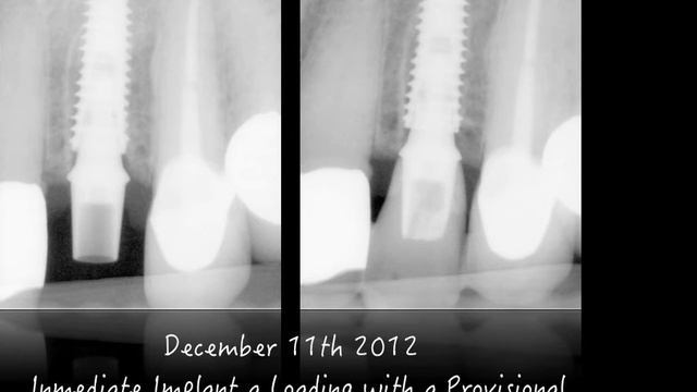 Inmediate Implant Neobiotech смотреть онлайн