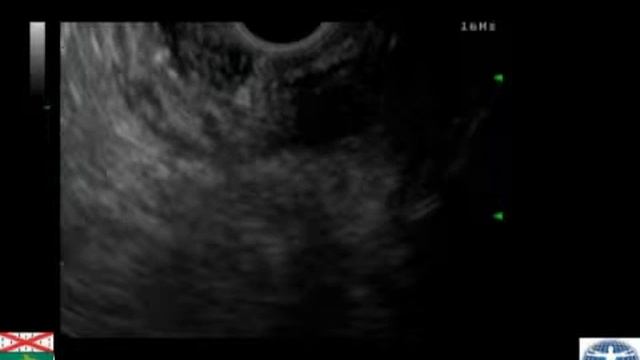 Stomach -- GIST with EUS FNA смотреть онлайн