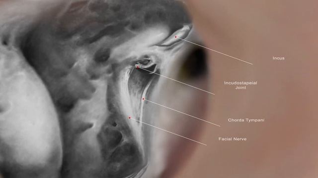 Mastoidectomy Anatomy