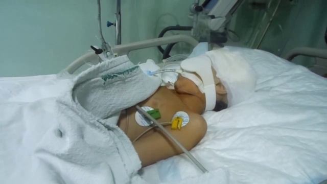 Three Year Old Girl Critically Injured by Terrorist Mortar, Syria (2015)