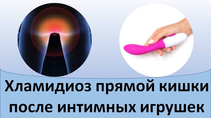Хламидиоз прямой кишки после интимных игрушек смотреть онлайн