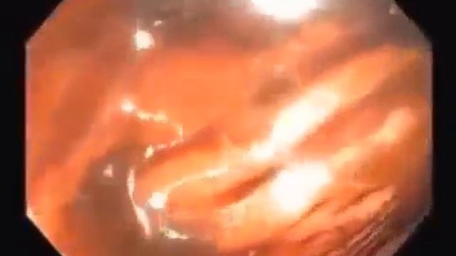 Видео кишечника смотреть онлайн