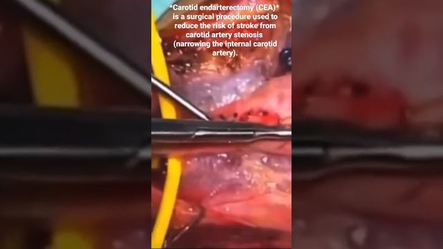 Carotid Endarterectomy смотреть онлайн