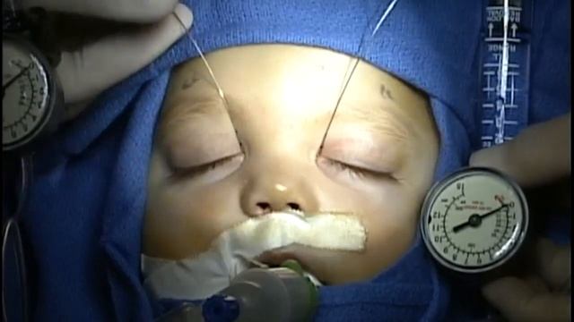 Tear Duct Probing and Balloon Dilation смотреть онлайн