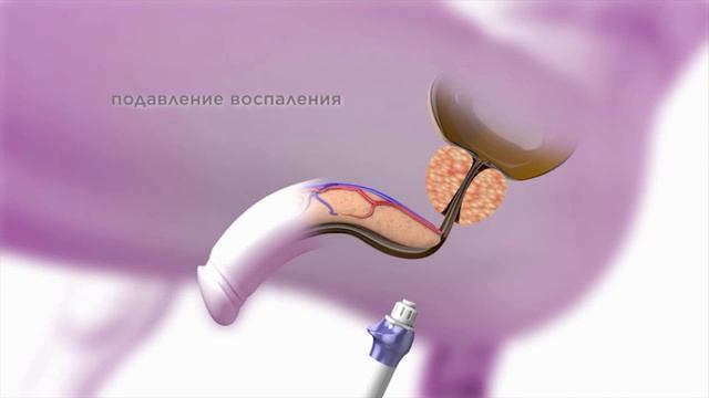 Лечение простатита методом УВТ смотреть онлайн