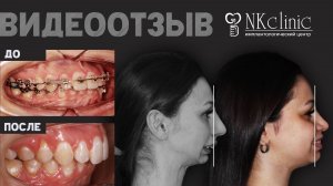 NKclinic - отзывы пациентов. Доктора исправили деформацию челюсти, установили титановые суставы