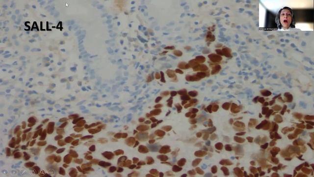 Tip-48;Gastric Adenocarcinoma with Enteroblastic Differentiation смотреть онлайн