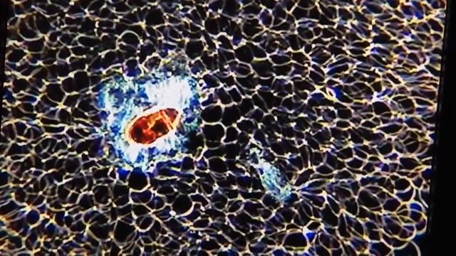 Darkfield view of White Blood Cell Neutrophil digesting foreign debris 2 смотреть онлайн