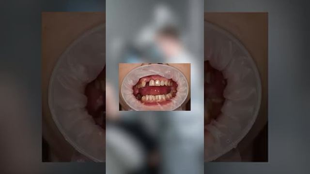 Восстановление зубов до/после  #стоматологиясириус