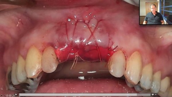 Ora-Aid webinar english 2020