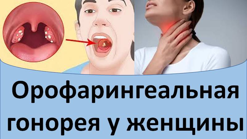 Орофарингеальная гонорея у женщины смотреть онлайн