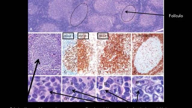 Linfoma No Hodgkin смотреть онлайн
