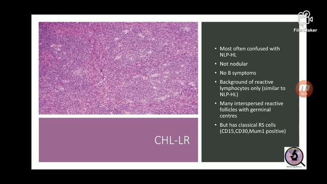 Lymphomas смотреть онлайн