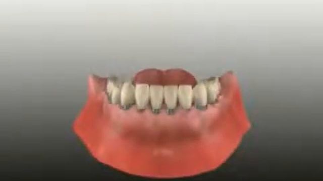 Teeth and dental Implants Auckland | Epsom Dentists Ph 09) 630 6883 смотреть онлайн