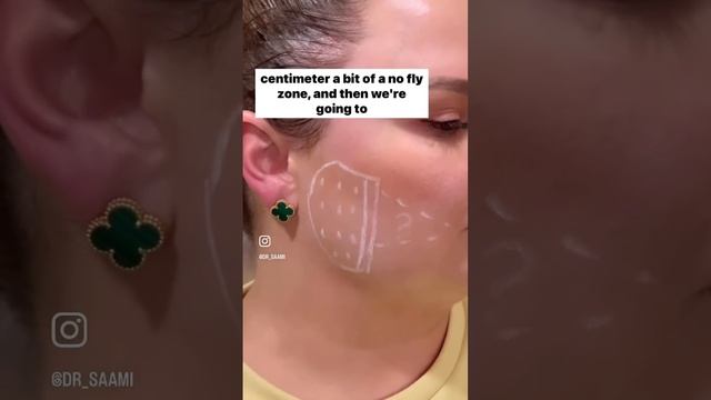 Masseter botox смотреть онлайн