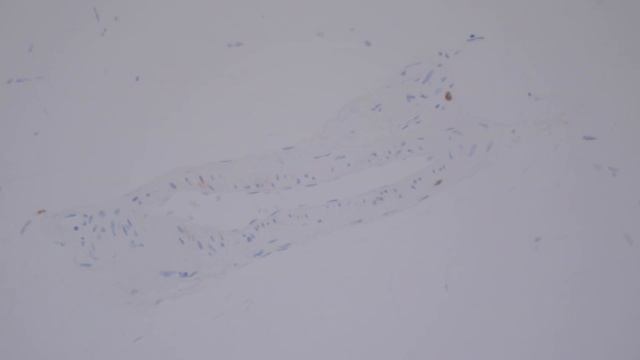 Immunohistochemistry in Normal Skin: p63, EMA, desmin, SMA, CD34, Factor XIIIa смотреть онлайн