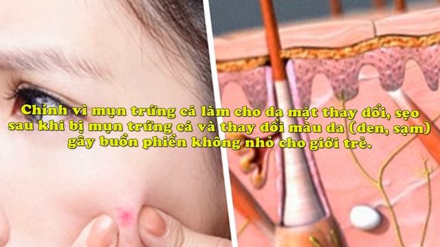 Cách ngừa mụn trứng cá смотреть онлайн