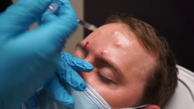 Male Botox - "Brotox" - With Dr. Rebowe at The Park Clinic смотреть онлайн