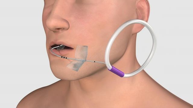 Неотложные состояния 2896 Cook Extubation Procedure ProRez HD смотреть онлайн