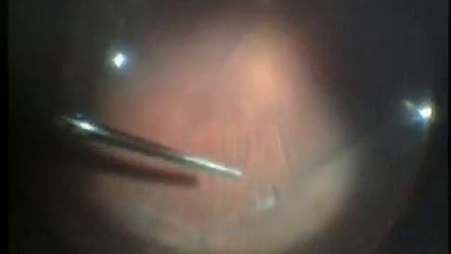Visalis V 500 vitrectomy with Resight for Retinal detachment смотреть онлайн
