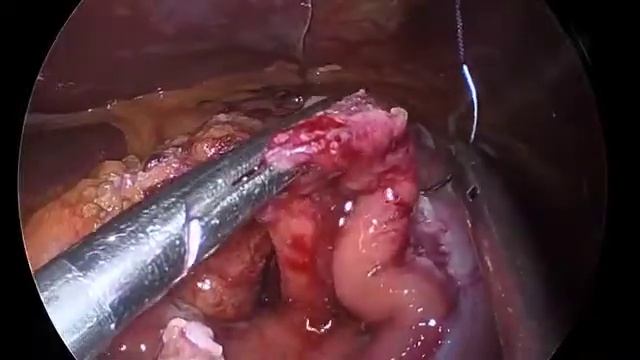 Gastric GIST (Gastrointestinal Stromal Tumor) Resection Surgery Video | Laparoscopic surgery смотреть онлайн