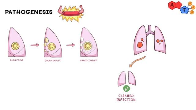 Mycobacterium tuberculosis TB смотреть онлайн