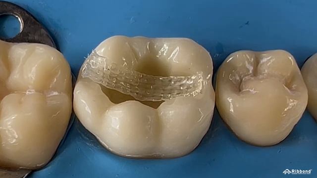 Композитные реставрации Ribbond