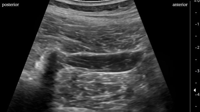 Quadratus lumborum (QL) block: Anterior approach смотреть онлайн