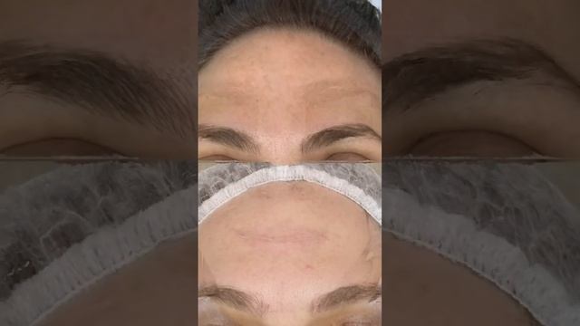До/после - шлифовка СО2. #допосле #beforeafter #доипосле #пигментация #пигментныепятна #со2 #fyp смотреть онлайн