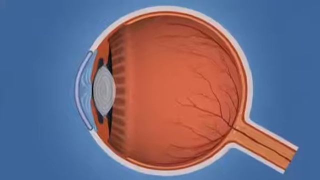 Argon & Selective Laser Trabeculoplasty (ALT & SLT) смотреть онлайн