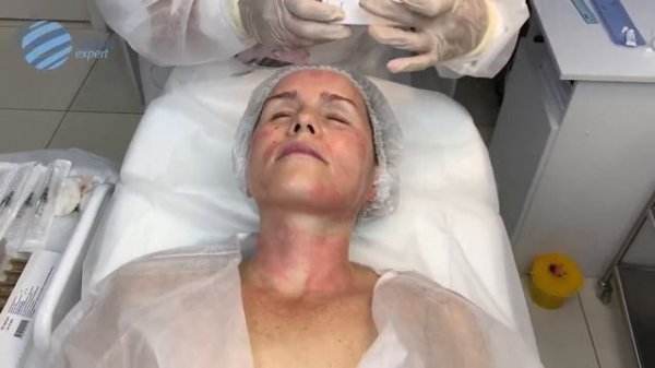 Видео протокол процедуры коллагенотерапии с Linerase