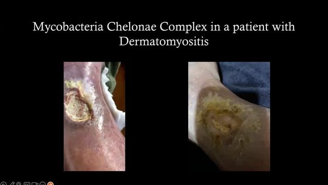 Atypical Ulcers - What the Heck is this? смотреть онлайн