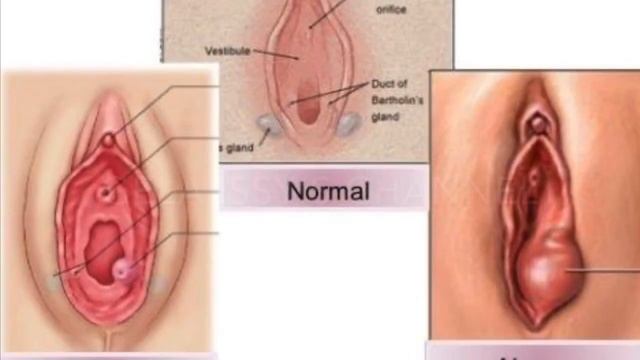 Bartholin Cyst Infection-Cause And Possible Remedies смотреть онлайн