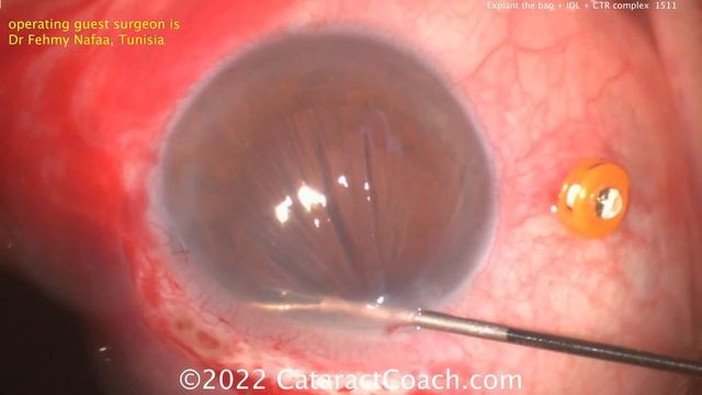 CataractCoach 1511: explant the bag + IOL + CTR complex смотреть онлайн