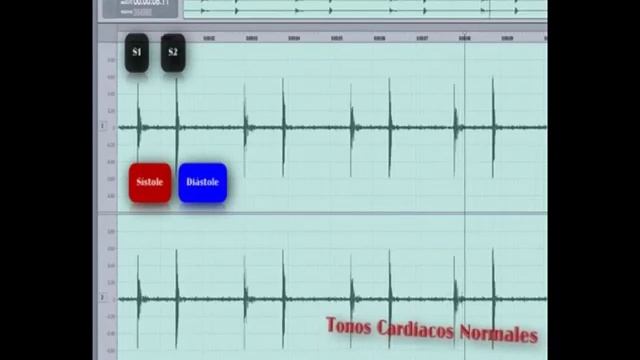 Podcast 12: Curso de Valvulopatias Parte 1 смотреть онлайн