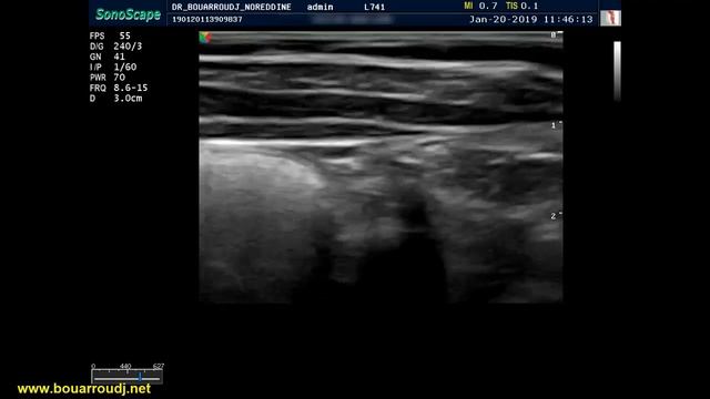 Quadratus lumborum QLB block смотреть онлайн
