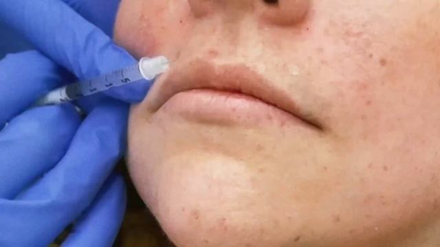 Fix a Gummy Smile with Botox смотреть онлайн