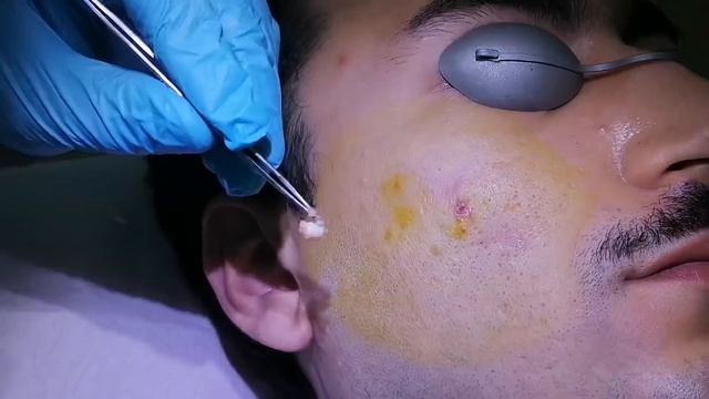 Yüzdeki epidermal kistin kolayca çıkarılması смотреть онлайн