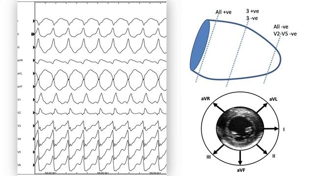 VT Ablation in a Patient with Emery-Dreifuss Muscular Dystrophy смотреть онлайн