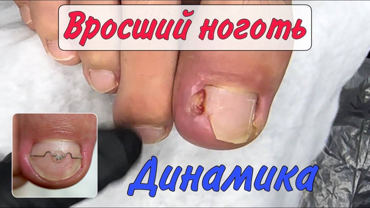 Вросший ноготь и установка скобы 3ТО смотреть онлайн
