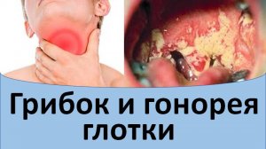 Грибок и гонорея в глотке