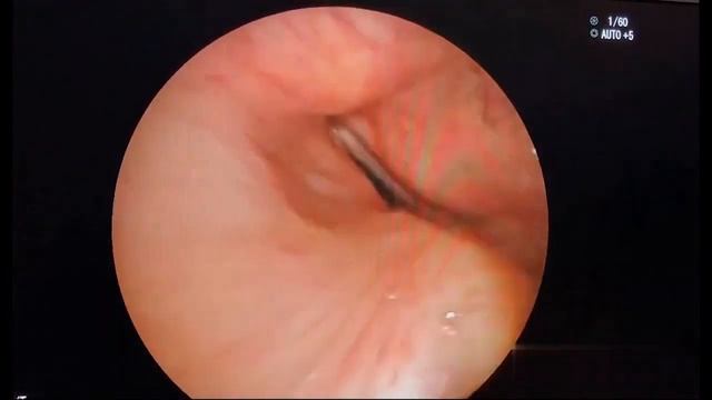 Asvide: Postoperative re-stenosis of the anastomosis with a residual caliber less than 50% of the.. смотреть онлайн