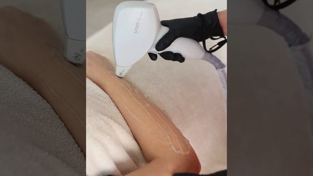 Лазерна епіляція на американському лазері Lumenis Light Sheer смотреть онлайн