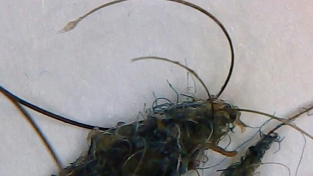 Morgellons Disease The Silent Pandemic -March 2020 - Eczema, Shingles, Fibromyalgia, & Lyme Disease
