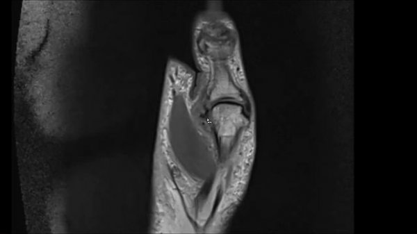 Stener Lesion (Skier's Thumb) on MRI