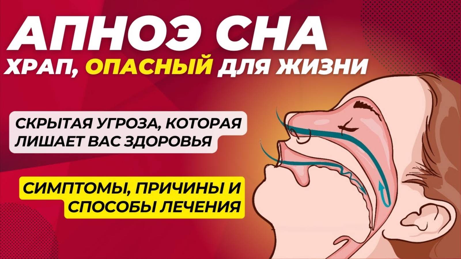 От храпа до серьезных последствий: всё о синдроме апноэ сна смотреть онлайн