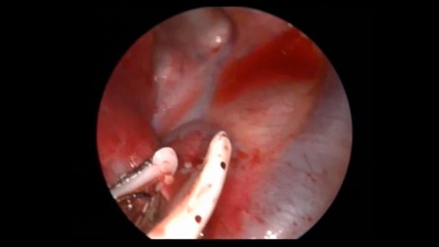 simultaneous uniportal VATS lobectomy and pectus repair смотреть онлайн